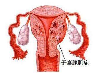 腺肌症的最新疗法,腺肌症治疗新进展